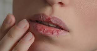 Chapped Lips Causes: इस विटामिन की कमी से फटने लगते हैं आपके होंठ, दिखने लगती हैं दरारें 2 image 21