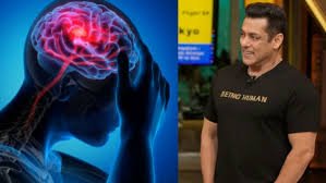 Salman Khan News: सलमान खान को है ब्रेन एन्यूरिज्म और एवी मालफॉर्मेशन डायग्नोसिस, जानिए कितनी खतरनाक है ये बीमारी 2 image 318